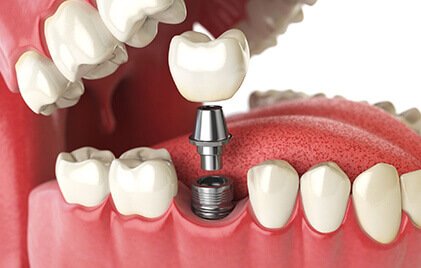 dental implants Shela, Ahmedabad