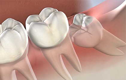wisdom tooth extraction